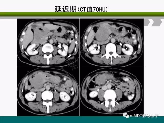 【PPT】胃外生性肿瘤的诊断与鉴别诊断