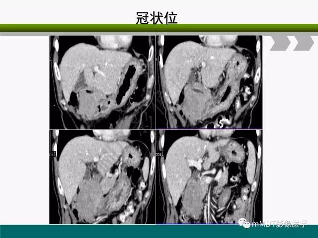 【PPT】胃外生性肿瘤的诊断与鉴别诊断