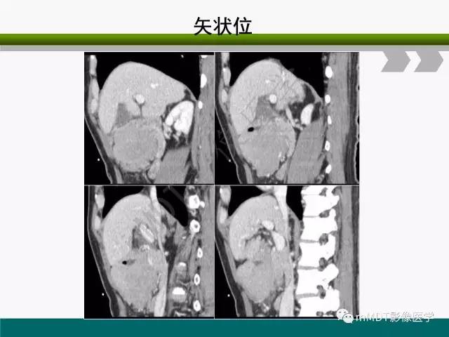 【PPT】胃外生性肿瘤的诊断与鉴别诊断