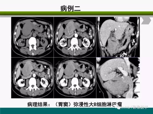 【PPT】胃外生性肿瘤的诊断与鉴别诊断