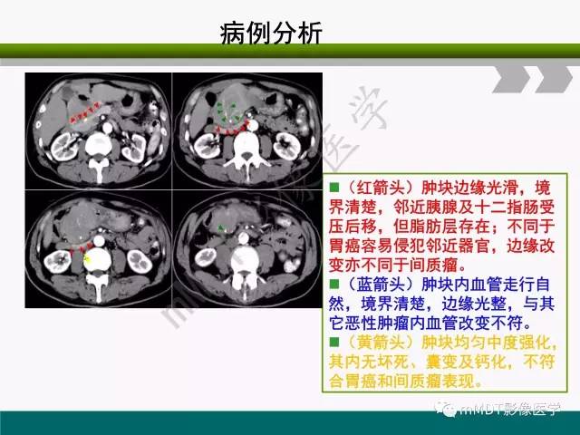 【PPT】胃外生性肿瘤的诊断与鉴别诊断