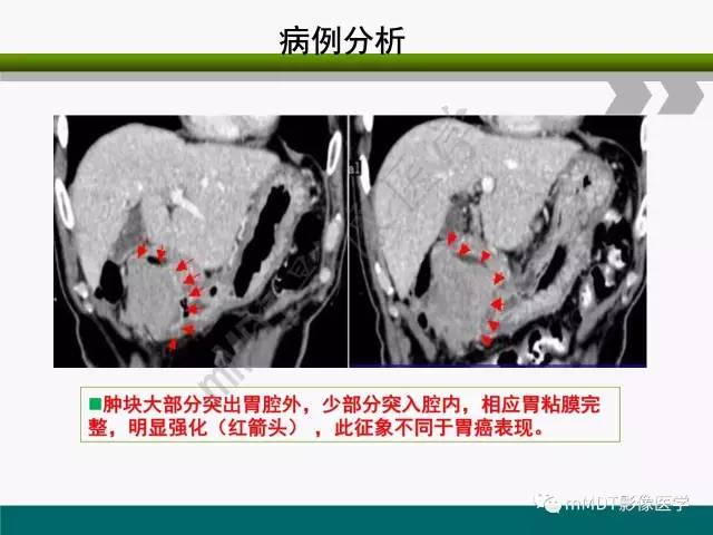 【PPT】胃外生性肿瘤的诊断与鉴别诊断
