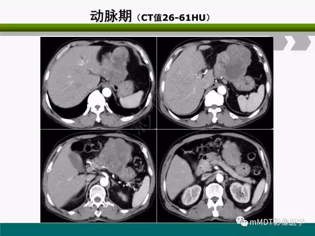 【PPT】胃外生性肿瘤的诊断与鉴别诊断