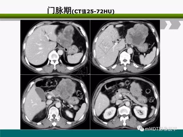 【PPT】胃外生性肿瘤的诊断与鉴别诊断
