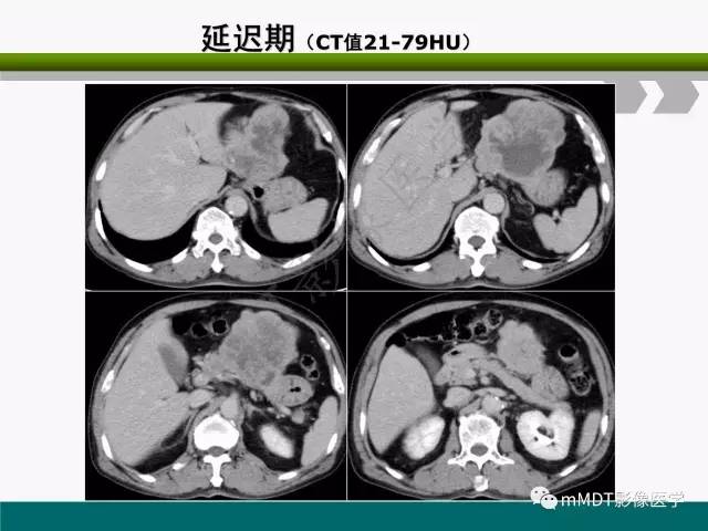 【PPT】胃外生性肿瘤的诊断与鉴别诊断