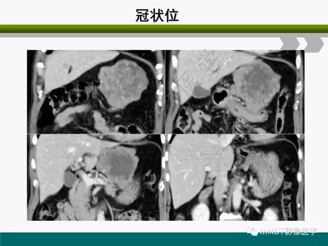 【PPT】胃外生性肿瘤的诊断与鉴别诊断