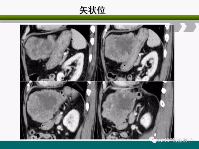 【PPT】胃外生性肿瘤的诊断与鉴别诊断