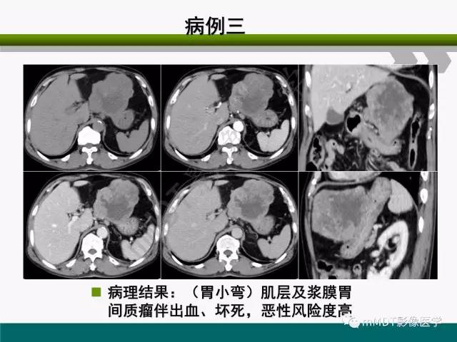 【PPT】胃外生性肿瘤的诊断与鉴别诊断