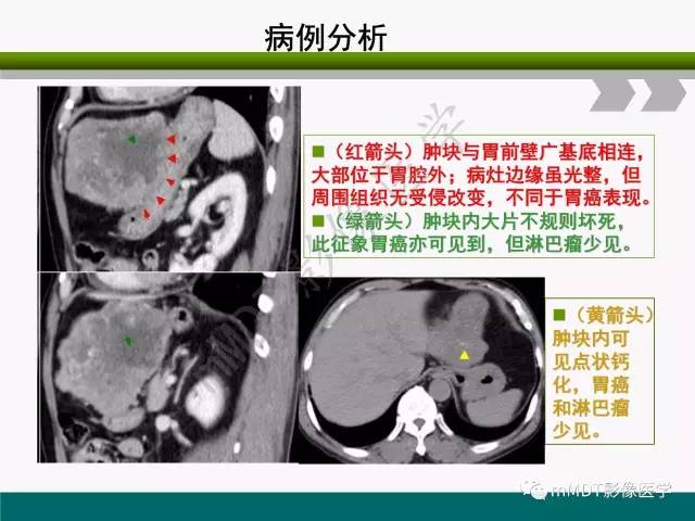 【PPT】胃外生性肿瘤的诊断与鉴别诊断