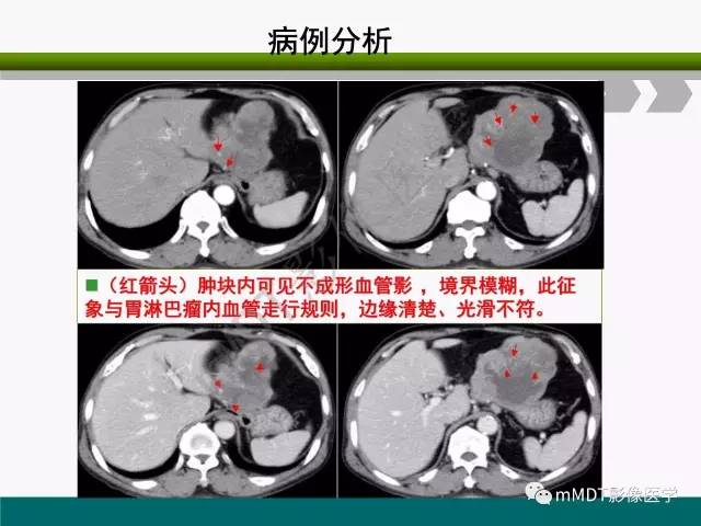 【PPT】胃外生性肿瘤的诊断与鉴别诊断