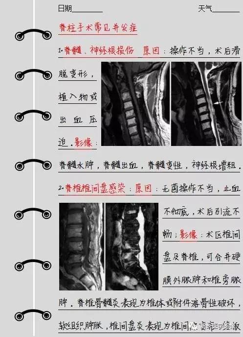 脊柱术后我们需要注意的4个并发症