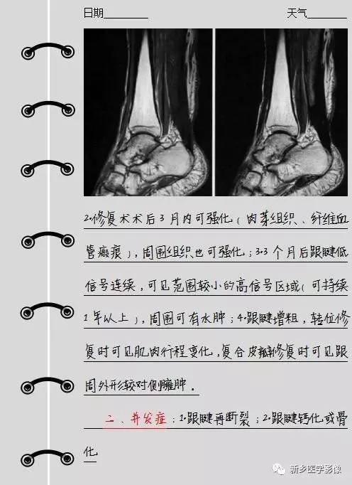 跟腱断裂以后，我们需要关注的内容