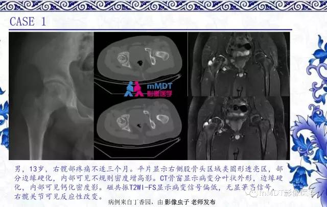 【PPT】长骨骨端髓内肿瘤的影像学诊断