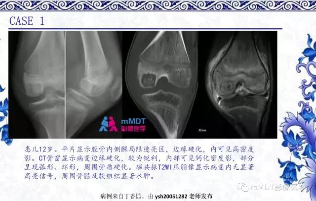 【PPT】长骨骨端髓内肿瘤的影像学诊断