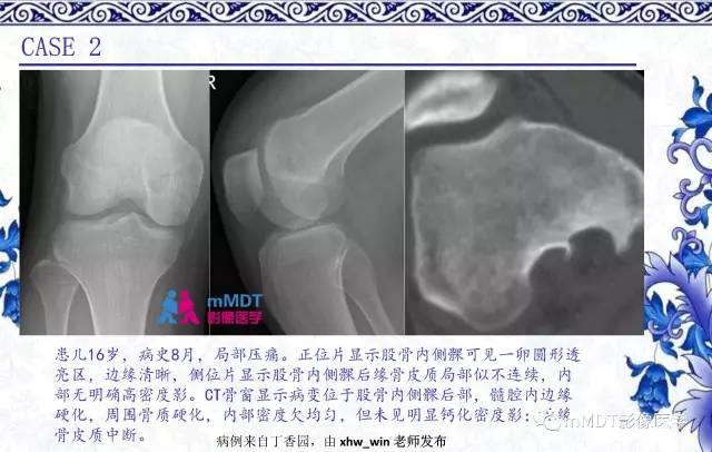 【PPT】长骨骨端髓内肿瘤的影像学诊断