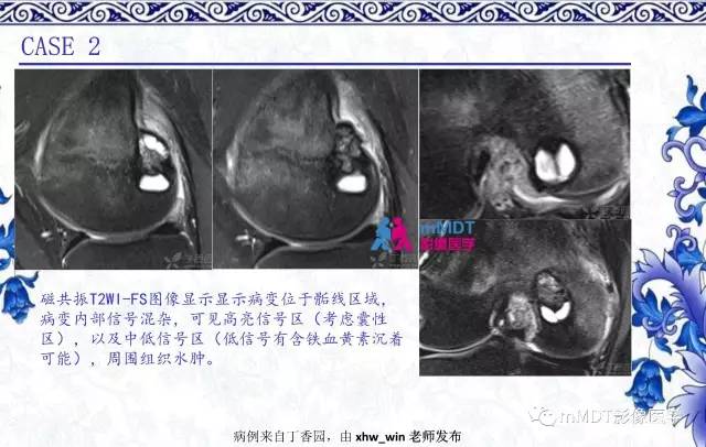 【PPT】长骨骨端髓内肿瘤的影像学诊断