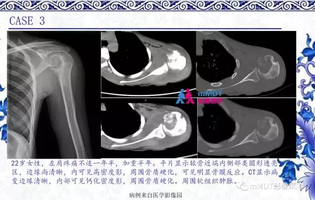 【PPT】长骨骨端髓内肿瘤的影像学诊断