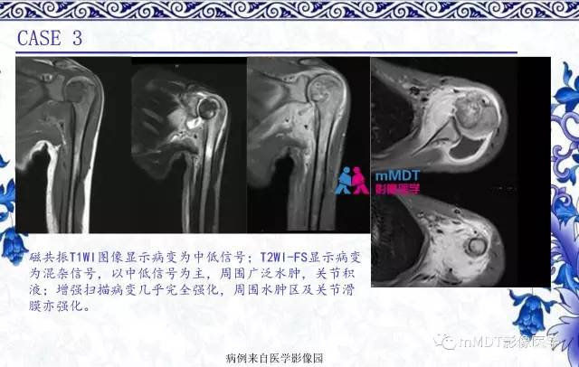 【PPT】长骨骨端髓内肿瘤的影像学诊断