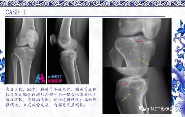 【PPT】长骨骨端髓内肿瘤的影像学诊断