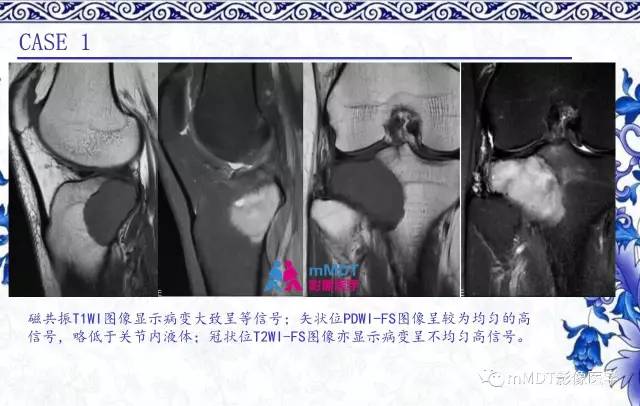 【PPT】长骨骨端髓内肿瘤的影像学诊断