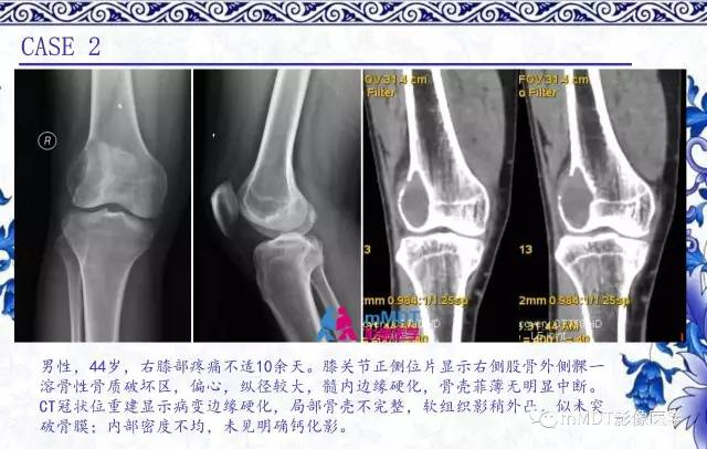 【PPT】长骨骨端髓内肿瘤的影像学诊断