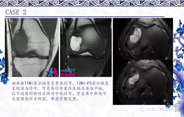 【PPT】长骨骨端髓内肿瘤的影像学诊断