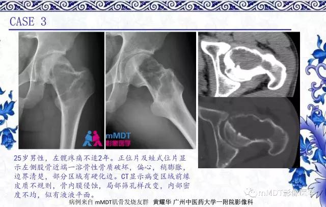 【PPT】长骨骨端髓内肿瘤的影像学诊断