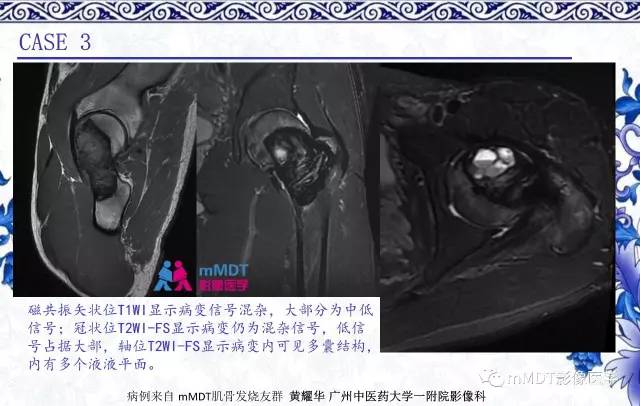 【PPT】长骨骨端髓内肿瘤的影像学诊断