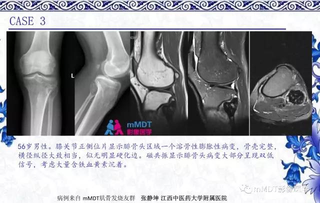 【PPT】长骨骨端髓内肿瘤的影像学诊断