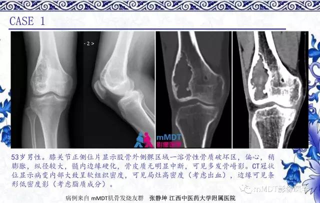 【PPT】长骨骨端髓内肿瘤的影像学诊断