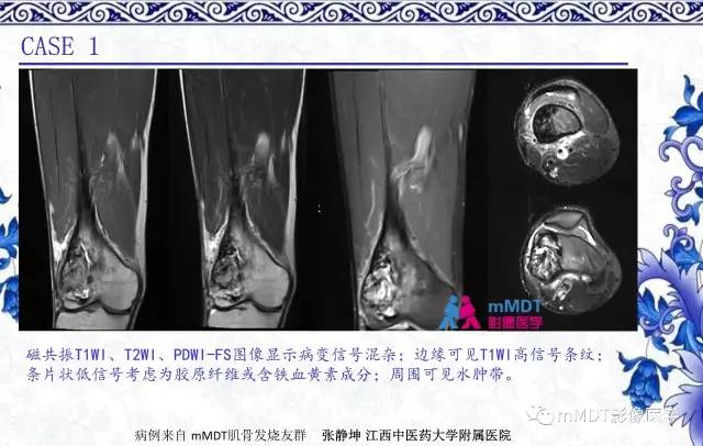 【PPT】长骨骨端髓内肿瘤的影像学诊断
