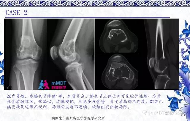 【PPT】长骨骨端髓内肿瘤的影像学诊断