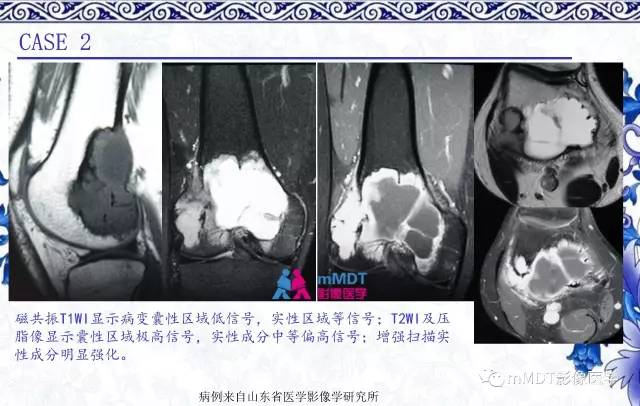 【PPT】长骨骨端髓内肿瘤的影像学诊断