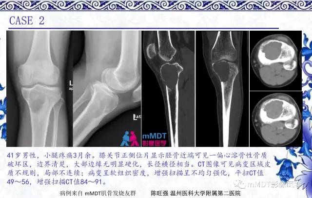 【PPT】长骨骨端髓内肿瘤的影像学诊断