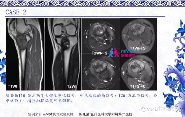 【PPT】长骨骨端髓内肿瘤的影像学诊断