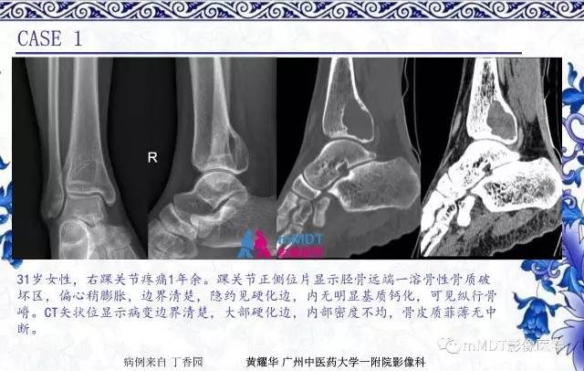 【PPT】长骨骨端髓内肿瘤的影像学诊断