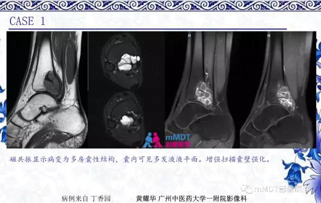 【PPT】长骨骨端髓内肿瘤的影像学诊断