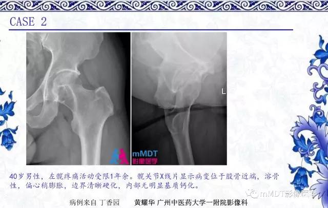 【PPT】长骨骨端髓内肿瘤的影像学诊断