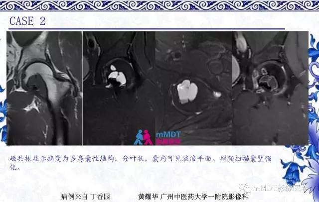 【PPT】长骨骨端髓内肿瘤的影像学诊断