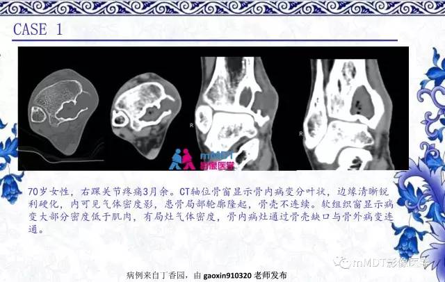 【PPT】长骨骨端髓内肿瘤的影像学诊断