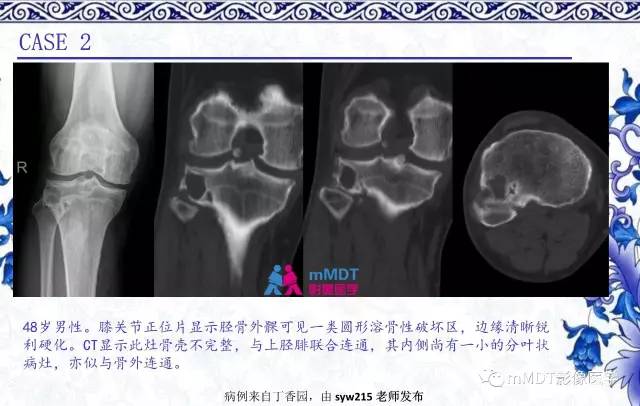 【PPT】长骨骨端髓内肿瘤的影像学诊断