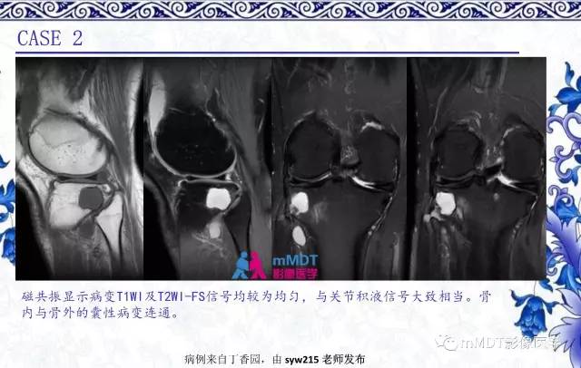 【PPT】长骨骨端髓内肿瘤的影像学诊断