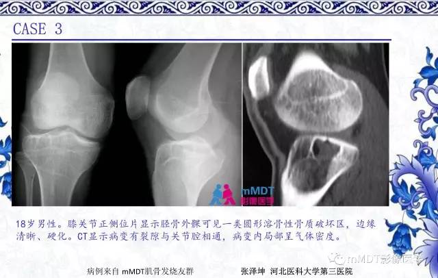 【PPT】长骨骨端髓内肿瘤的影像学诊断