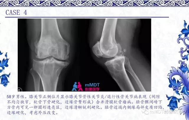 【PPT】长骨骨端髓内肿瘤的影像学诊断
