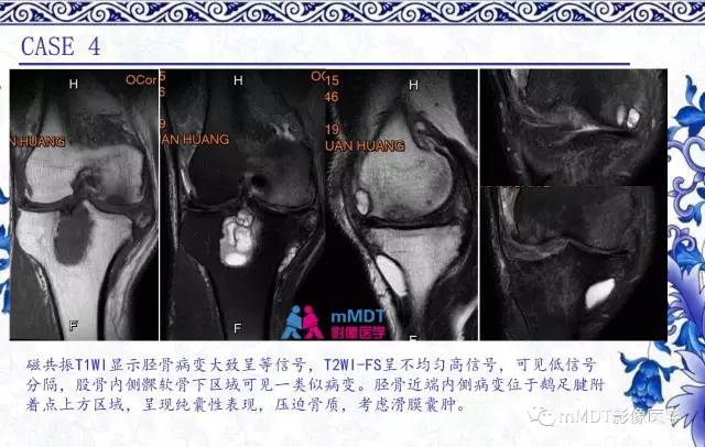 【PPT】长骨骨端髓内肿瘤的影像学诊断