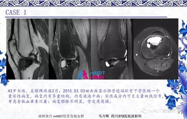 【PPT】长骨骨端髓内肿瘤的影像学诊断