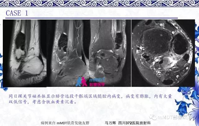 【PPT】长骨骨端髓内肿瘤的影像学诊断