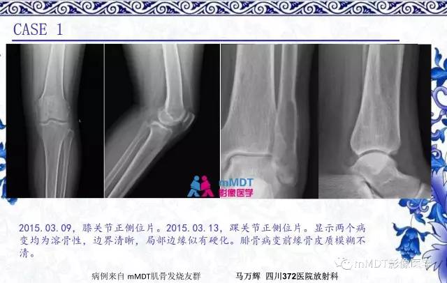 【PPT】长骨骨端髓内肿瘤的影像学诊断