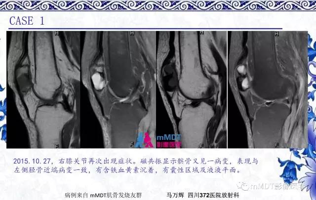 【PPT】长骨骨端髓内肿瘤的影像学诊断