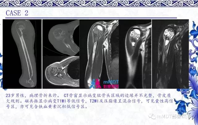 【PPT】长骨骨端髓内肿瘤的影像学诊断